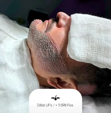 Foliculos-Barba.jpg.webp