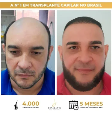 antesedepois.jpg.webp